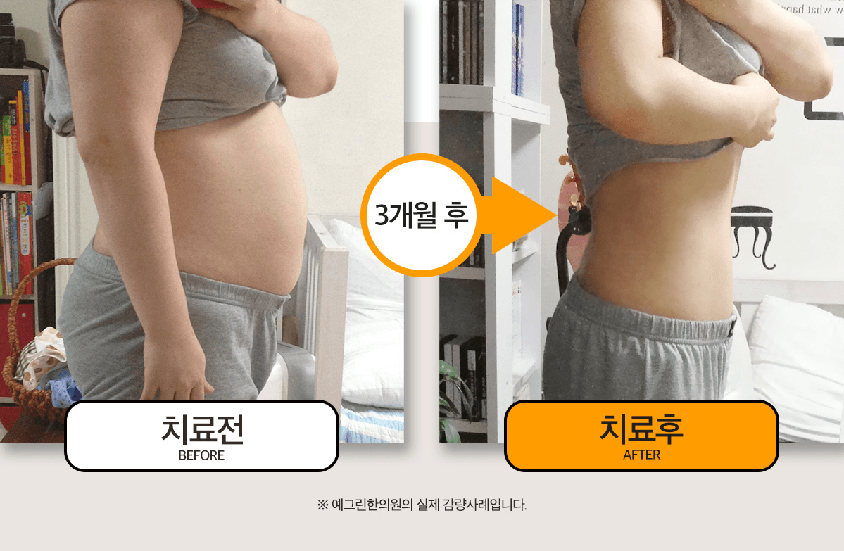 더예그린한의원 실제 다이어트 감량 전후 사례